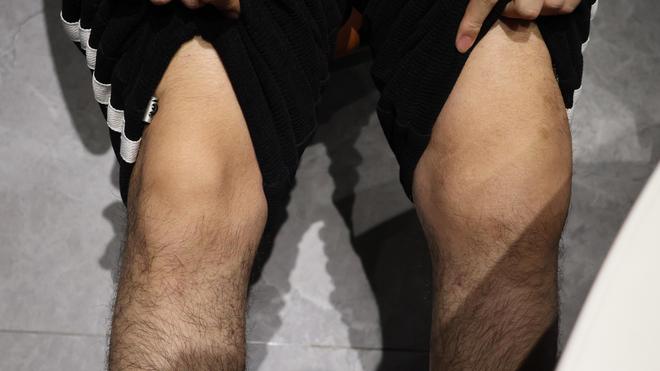 24岁患者2年多＂0元购＂139万元的药 被起诉追究刑责